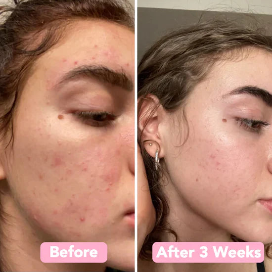 SpotEase™ | Sanfte Aufhellung für makellos gleichmäßige Haut