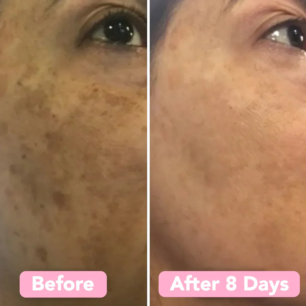 SpotEase™ | Sanfte Aufhellung für makellos gleichmäßige Haut