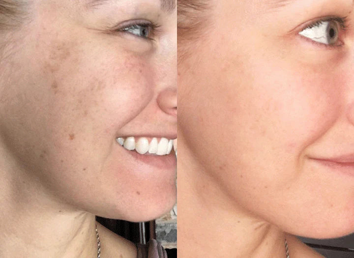 Modioza ™  Turmeric Sérum- Korrektur dunkler Flecken  (1+1 GRATIS)